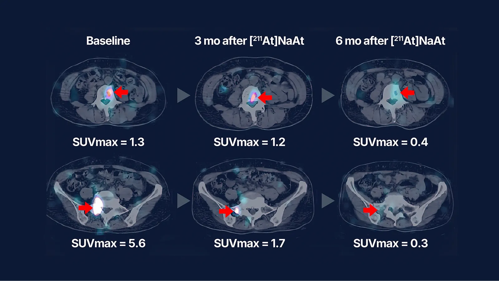 甲状腺癌患者における[211At]NaAt投与前後の131I集積画像の経時的変化